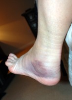 2009-02-08-02 SPRAINED ANKLE.jpg